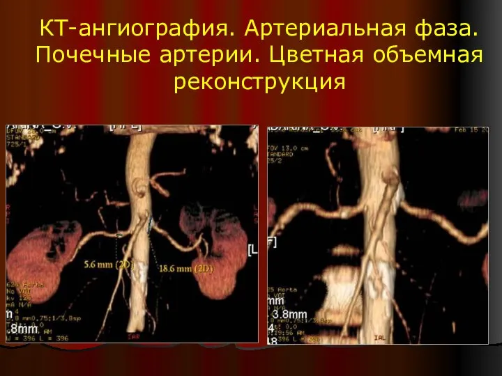 КТ-ангиография. Артериальная фаза. Почечные артерии. Цветная объемная реконструкция