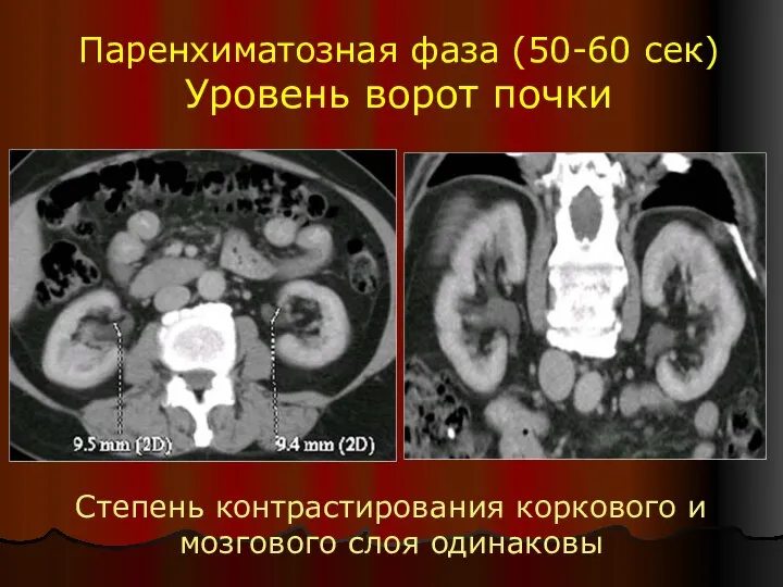 Паренхиматозная фаза (50-60 сек) Уровень ворот почки Степень контрастирования коркового и мозгового слоя одинаковы