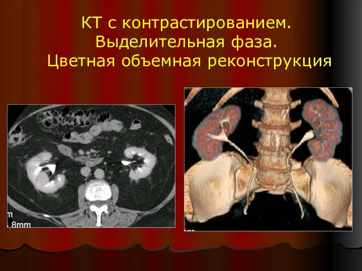 КТ с контрастированием. Выделительная фаза. Цветная объемная реконструкция