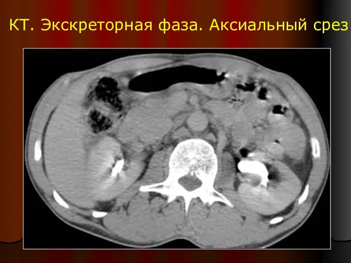 КТ. Экскреторная фаза. Аксиальный срез