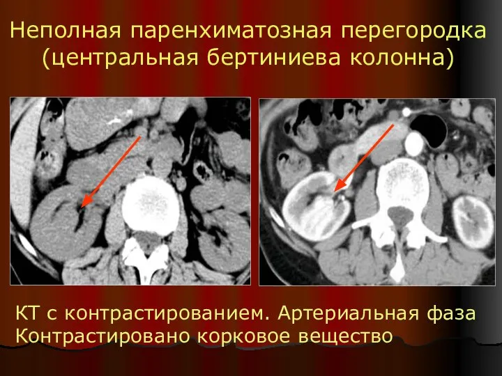 Неполная паренхиматозная перегородка (центральная бертиниева колонна) КТ с контрастированием. Артериальная фаза Контрастировано корковое вещество