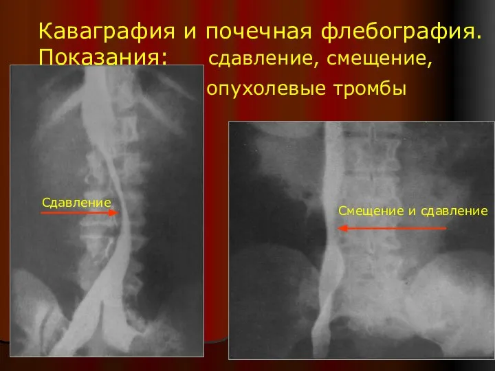 Каваграфия и почечная флебография. Показания: сдавление, смещение, опухолевые тромбы Сдавление Смещение и сдавление