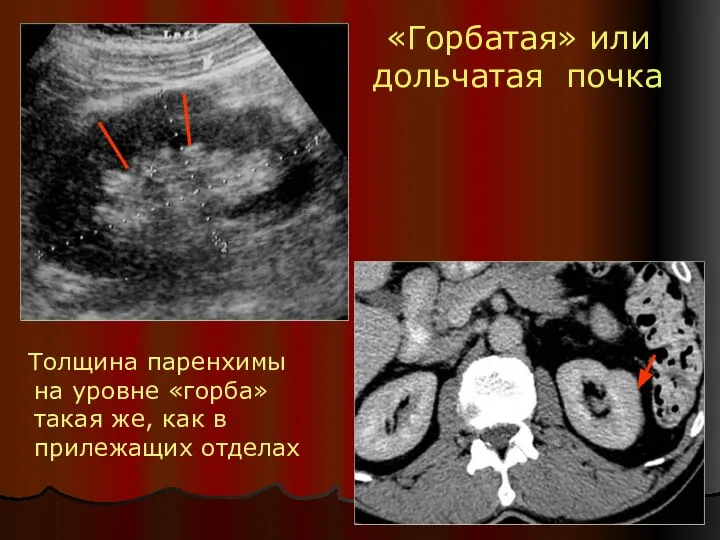 «Горбатая» или дольчатая почка Толщина паренхимы на уровне «горба» такая же, как в прилежащих отделах