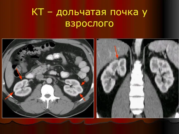 КТ – дольчатая почка у взрослого