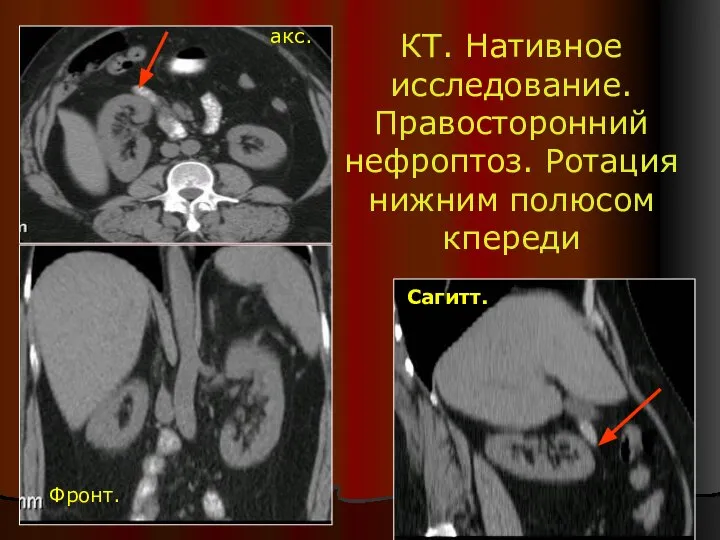 КТ. Нативное исследование. Правосторонний нефроптоз. Ротация нижним полюсом кпереди акс. Фронт. Сагитт.