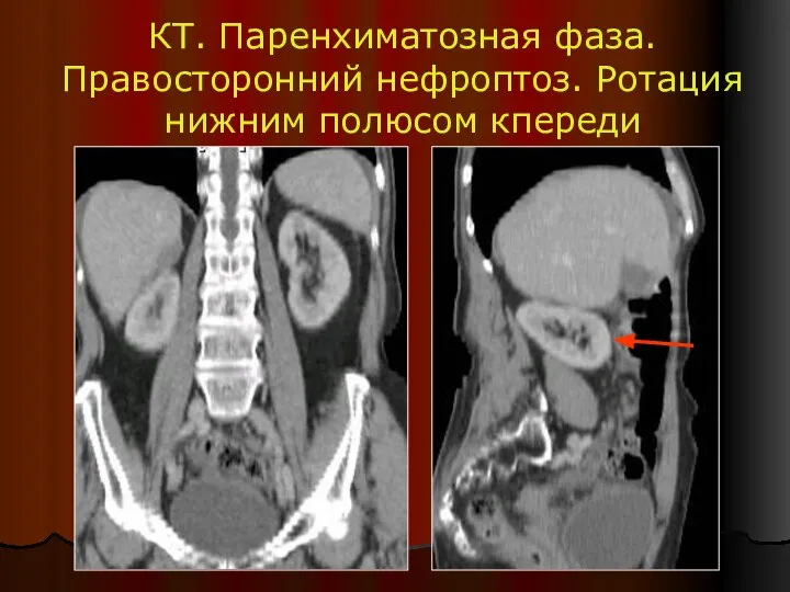 КТ. Паренхиматозная фаза. Правосторонний нефроптоз. Ротация нижним полюсом кпереди