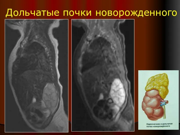 Дольчатые почки новорожденного