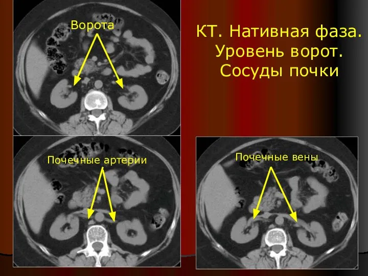 КТ. Нативная фаза. Уровень ворот. Сосуды почки Ворота Почечные артерии Почечные вены