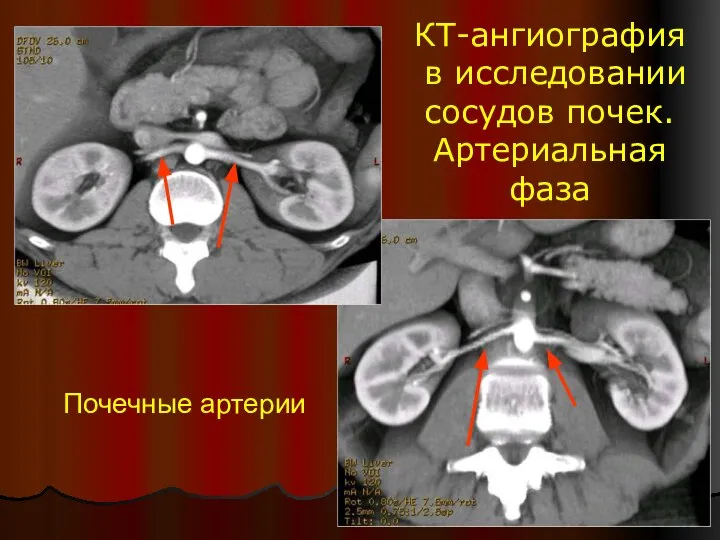 КТ-ангиография в исследовании сосудов почек. Артериальная фаза Почечные артерии