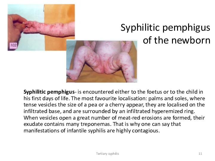 Tertiary syphilis Syphilitic pemphigus of the newborn Syphilitic pemphigus- is encountered