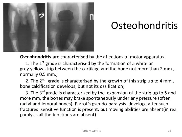 Tertiary syphilis Osteohondritis Osteohondritis-are characterised by the affections of motor apparatus: