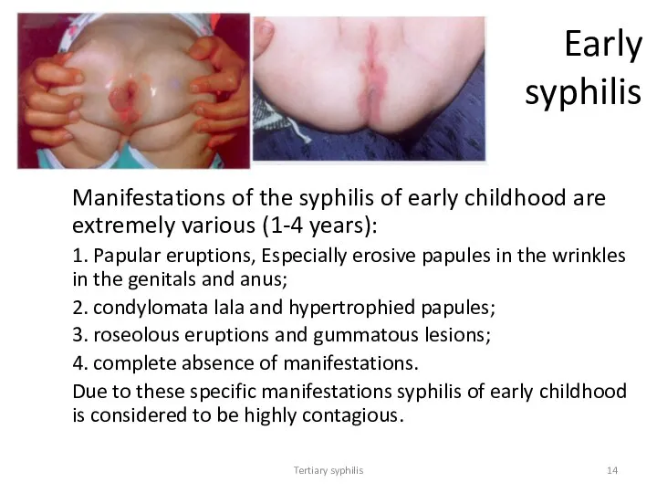 Tertiary syphilis Early syphilis Manifestations of the syphilis of early childhood