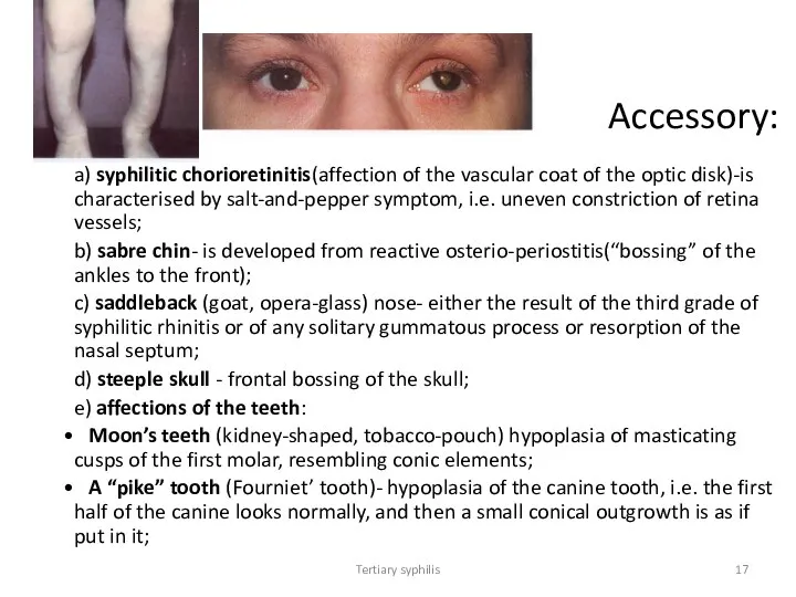 Tertiary syphilis Accessory: a) syphilitic chorioretinitis(affection of the vascular coat of