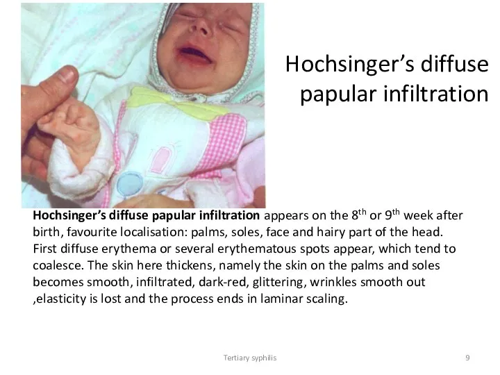 Tertiary syphilis Hochsinger’s diffuse papular infiltration Hochsinger’s diffuse papular infiltration appears