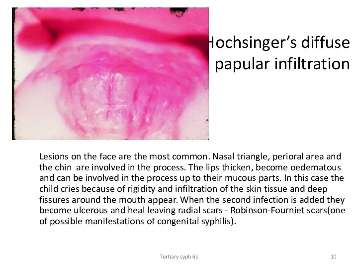 Tertiary syphilis Hochsinger’s diffuse papular infiltration Lesions on the face are