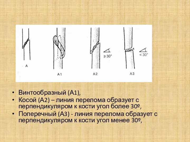 Винтообразный (А1), Косой (А2) – линия перелома образует с перпендикуляром к