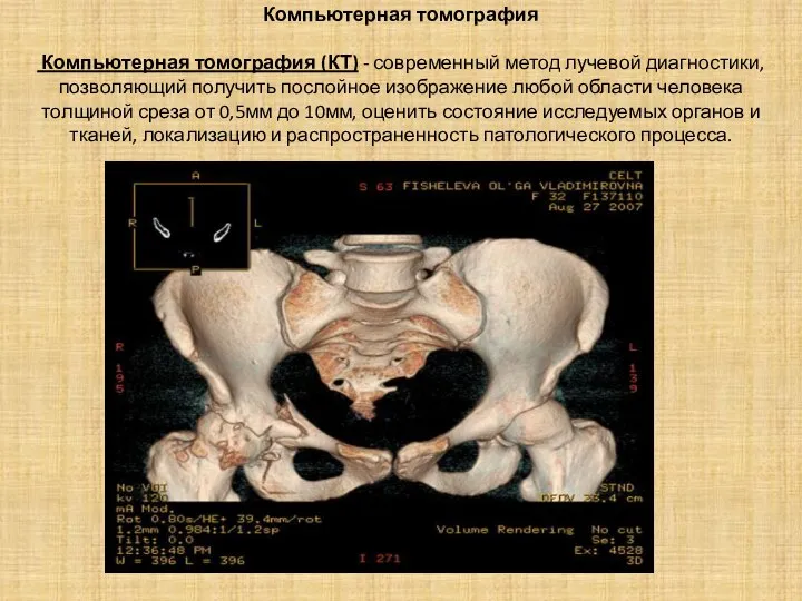Компьютерная томография Компьютерная томография (КТ) - современный метод лучевой диагностики, позволяющий