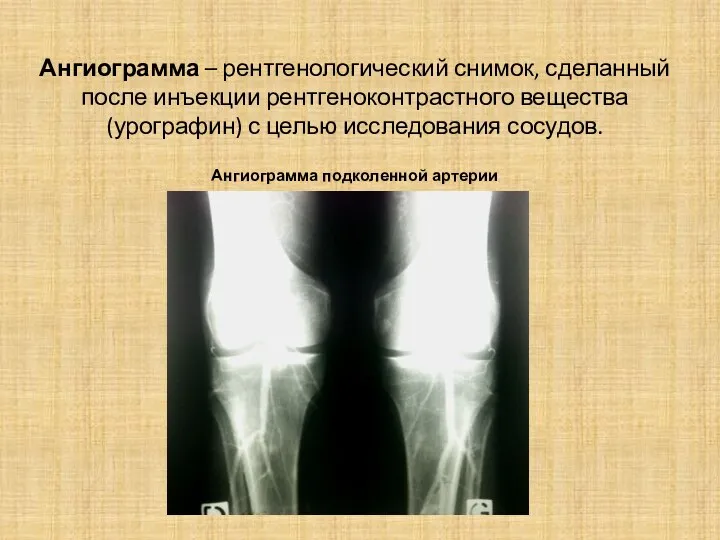 Ангиограмма – рентгенологический снимок, сделанный после инъекции рентгеноконтрастного вещества (урографин) с