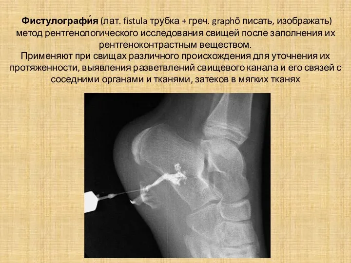 Фистулографи́я (лат. fistula трубка + греч. graphō писать, изображать) метод рентгенологического