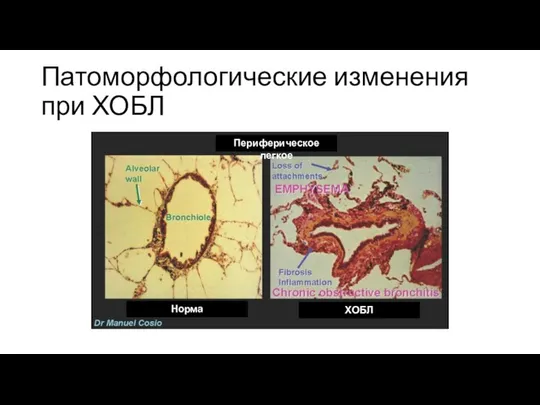 Патоморфологические изменения при ХОБЛ Периферическое легкое Норма ХОБЛ