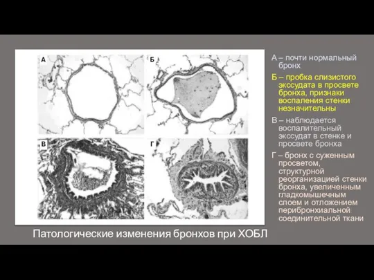 Патологические изменения бронхов при ХОБЛ A – почти нормальный бронх Б