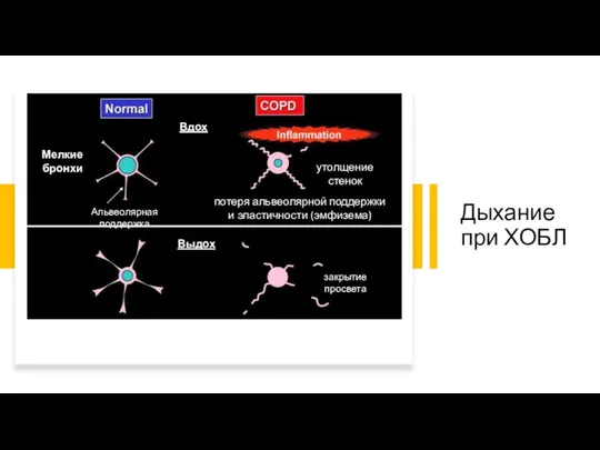 Дыхание при ХОБЛ Вдох Выдох Мелкие бронхи закрытие просвета Альвеолярная поддержка