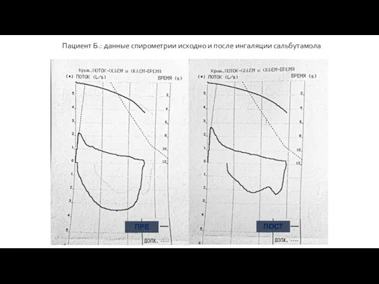 Пациент Б.: данные спирометрии исходно и после ингаляции сальбутамола ПОСТ ПРЕ
