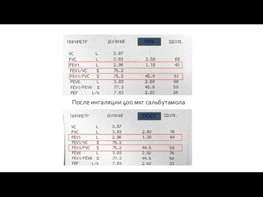 После ингаляции 400 мкг сальбутамола ПРЕ ПОСТ