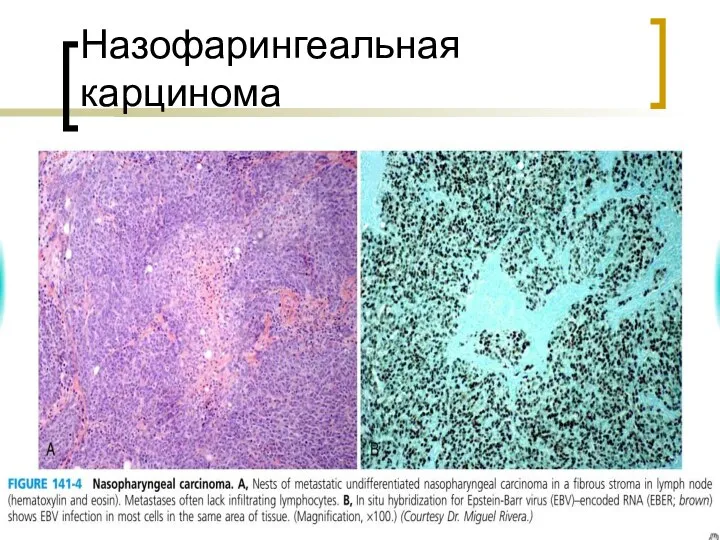 Назофарингеальная карцинома