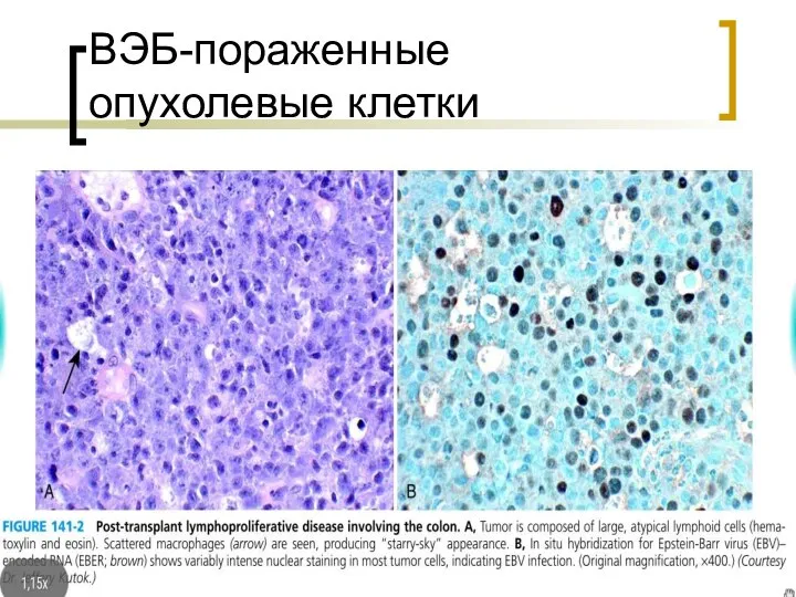 ВЭБ-пораженные опухолевые клетки