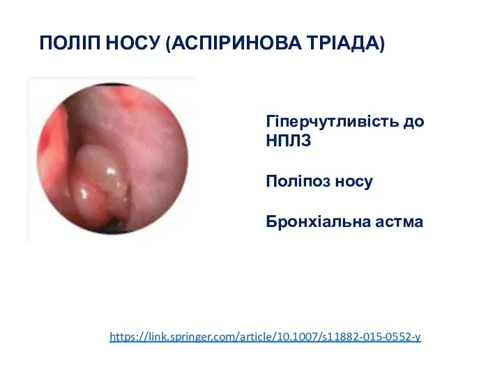 ПОЛІП НОСУ (АСПІРИНОВА ТРІАДА) https://link.springer.com/article/10.1007/s11882-015-0552-y Гіперчутливість до НПЛЗ Поліпоз носу Бронхіальна астма