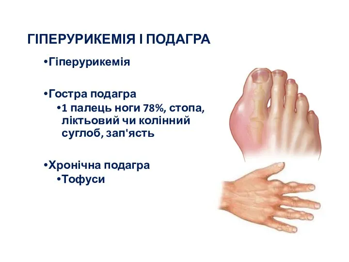 ГІПЕРУРИКЕМІЯ І ПОДАГРА Гіперурикемія Гостра подагра 1 палець ноги 78%, стопа,