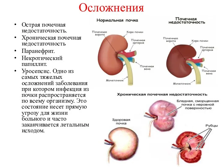 Осложнения Острая почечная недостаточность. Хроническая почечная недостаточность Паранефрит. Некротический папиллит. Уросепсис.