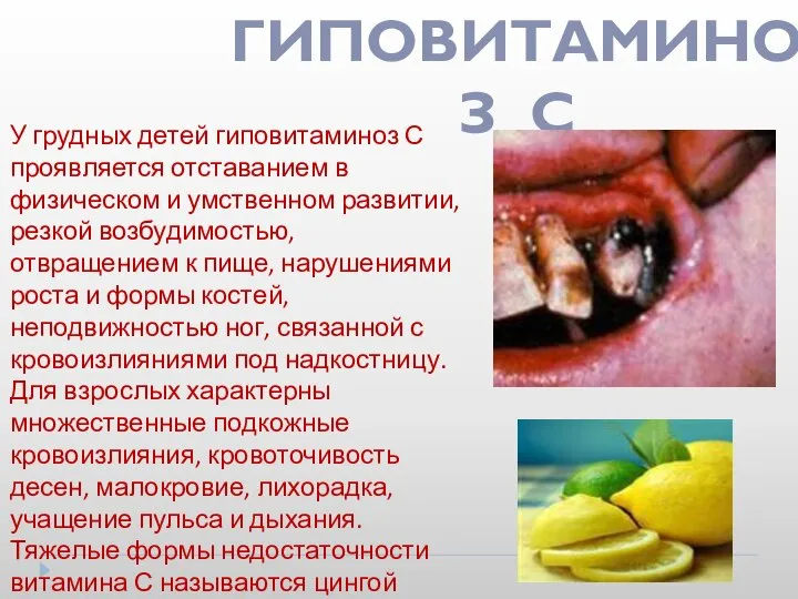 У грудных детей гиповитаминоз С проявляется отставанием в физическом и умственном