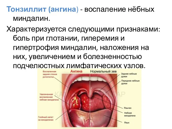 Тонзиллит (ангина) - воспаление нёбных миндалин. Характеризуется следующими признаками: боль при