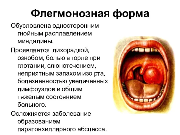 Флегмонозная форма Обусловлена односторонним гнойным расплавлением миндалины. Проявляется лихорадкой, ознобом, болью