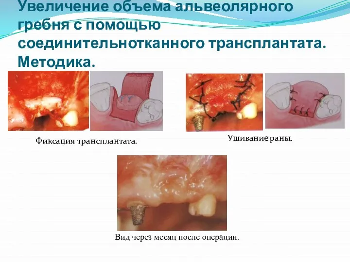 Увеличение объема альвеолярного гребня с помощью соединительнотканного трансплантата. Методика. Фиксация трансплантата.