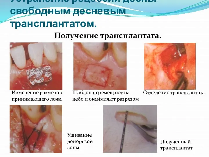 Устранение рецессии десны свободным десневым трансплантатом. Получение трансплантата. Измерение размеров принимающего