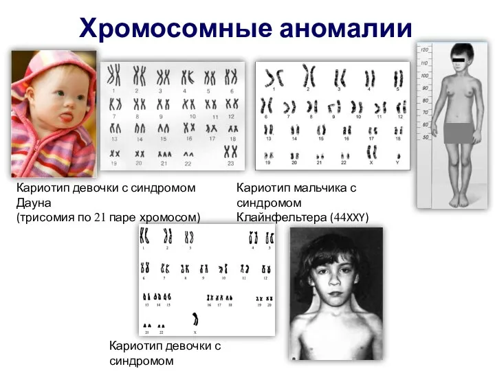 Хромосомные аномалии Кариотип девочки с синдромом Дауна (трисомия по 21 паре