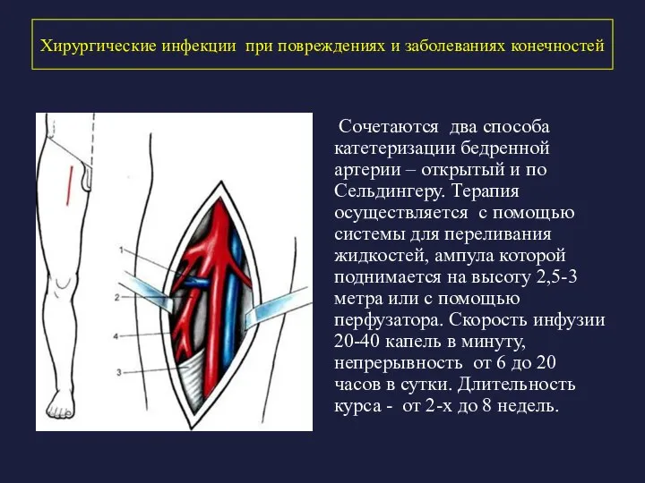 Хирургические инфекции при повреждениях и заболеваниях конечностей Сочетаются два способа катетеризации