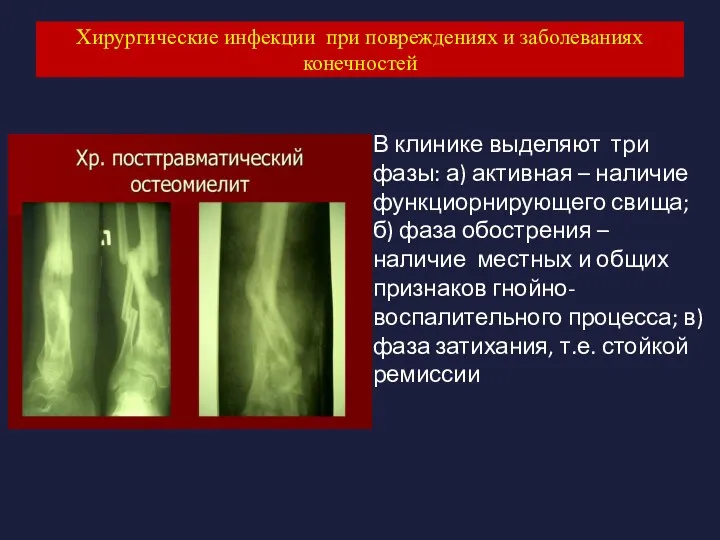 Хирургические инфекции при повреждениях и заболеваниях конечностей В клинике выделяют три