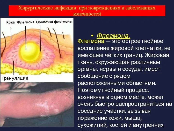 Хирургические инфекции при повреждениях и заболеваниях конечностей Флегмона. Флегмона — это