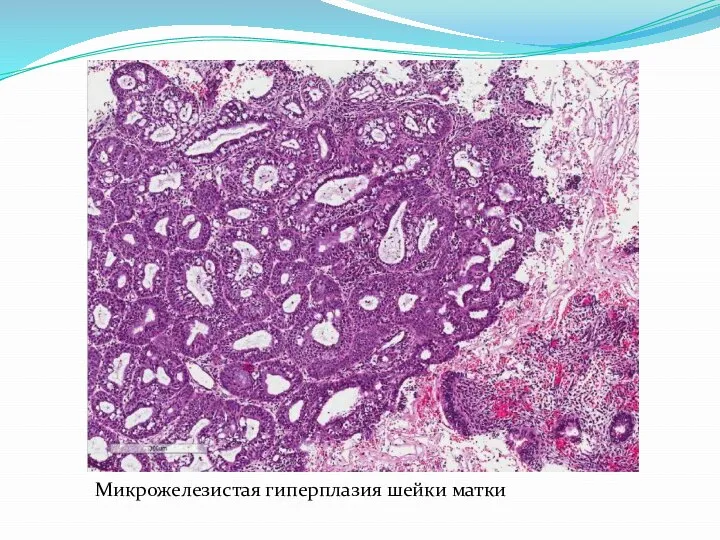 Микрожелезистая гиперплазия шейки матки