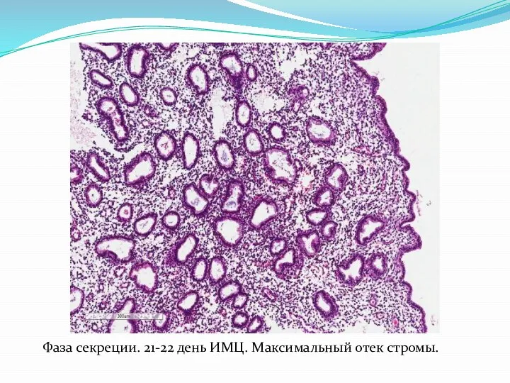 Фаза секреции. 21-22 день ИМЦ. Максимальный отек стромы.