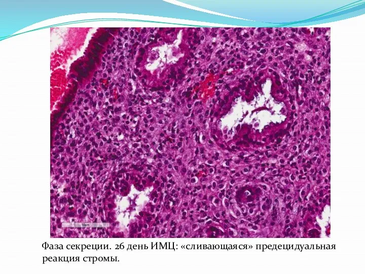 Фаза секреции. 26 день ИМЦ: «сливающаяся» предецидуальная реакция стромы.