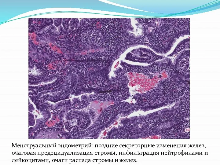 Менструальный эндометрий: поздние секреторные изменения желез, очаговая предецидуализация стромы, инфильтрация нейтрофилами