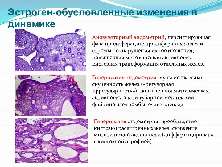 Ановуляторный эндометрий, персистирующая фаза пролиферации: пролиферация желез и стромы без нарушения