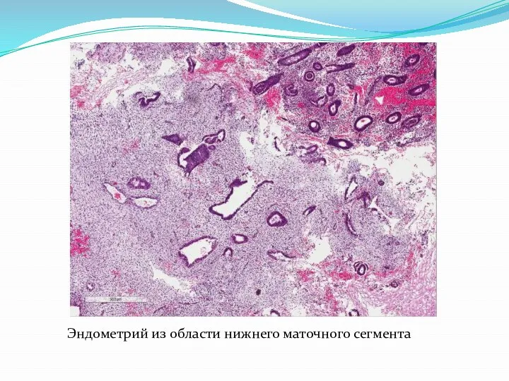 Эндометрий из области нижнего маточного сегмента