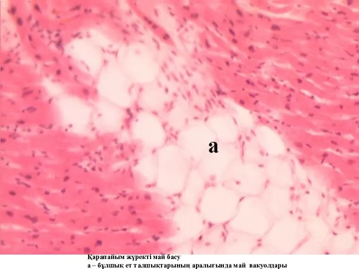 Қарапайым жүректі май басу а – бұлшық ет талшықтарының аралығында май вакуолдары
