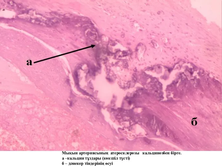 Мықын артериясының атеросклерозы кальцинозбен бірге. а –кальции тұздары (көкшіл түсті) б – дәнекер тіндерінің өсуі